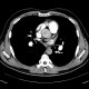 Chronic lung embolism: CT - Computed tomography